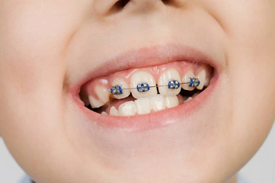 Conventional Metal Braces 
